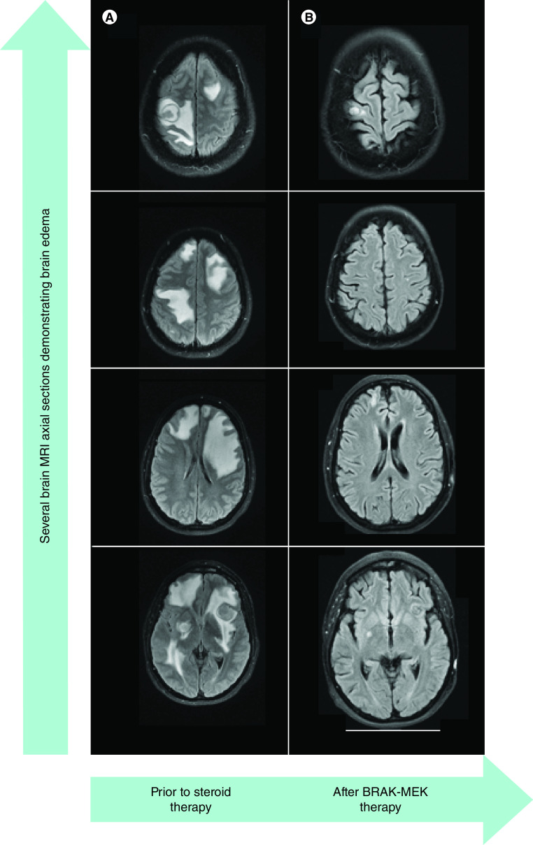 BRAF-MEK inhibitors as steroid-sparing bridge prior to checkpoint blockade therapy in symptomatic intracranial melanoma.