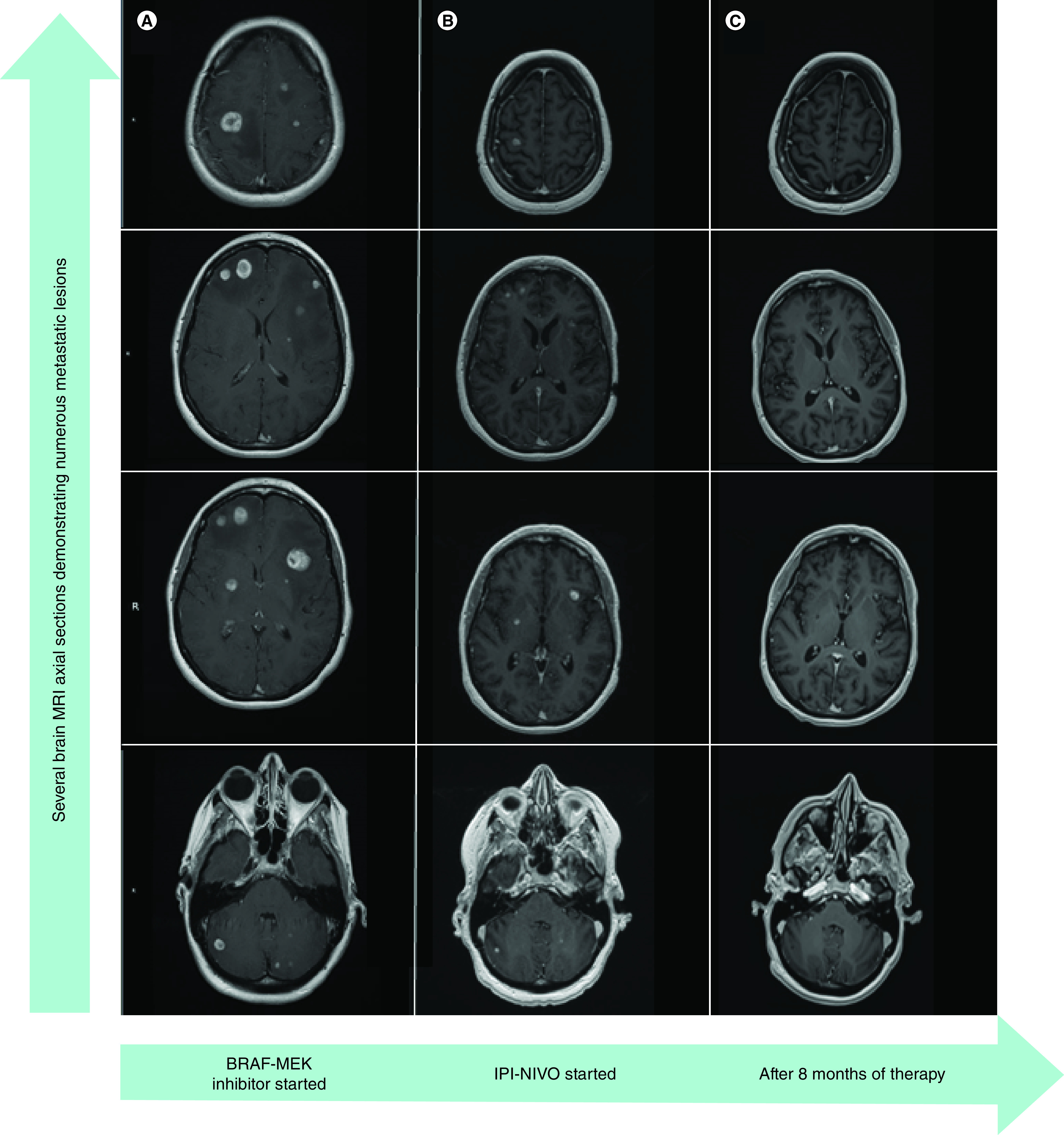 BRAF-MEK inhibitors as steroid-sparing bridge prior to checkpoint blockade therapy in symptomatic intracranial melanoma.