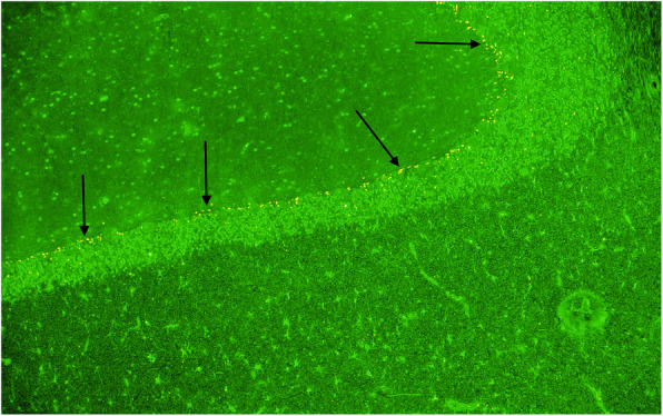 Indirect immunofluorescent assay as an aid in the diagnosis of suspected immune mediated ataxias.