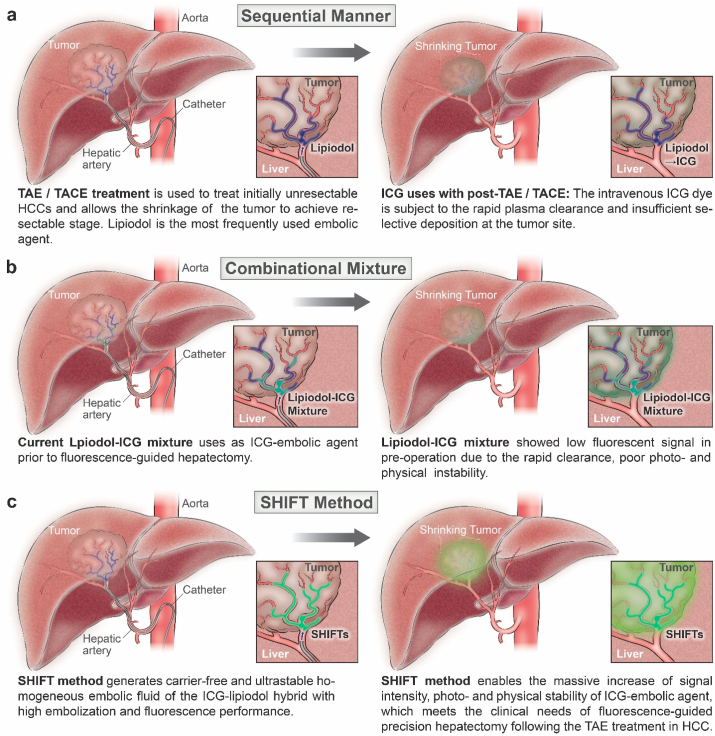 Bridging the preoperative gap of precision hepatectomy: Superstable homogeneous iodinated formulation technology