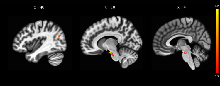 Intermittent theta burst stimulation for negative symptoms of schizophrenia-A double-blind, sham-controlled pilot study.