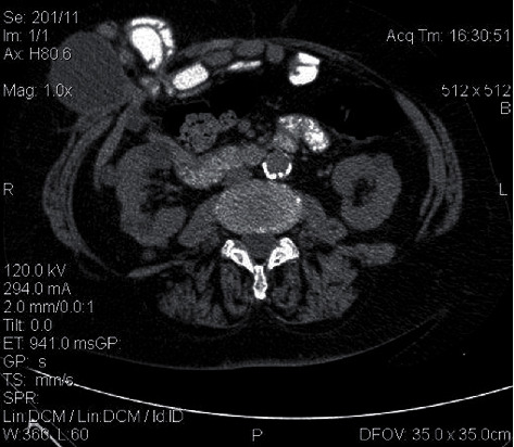 Parastomal Gallbladder Herniation as an Incidental Preoperative Computed Tomography Finding.