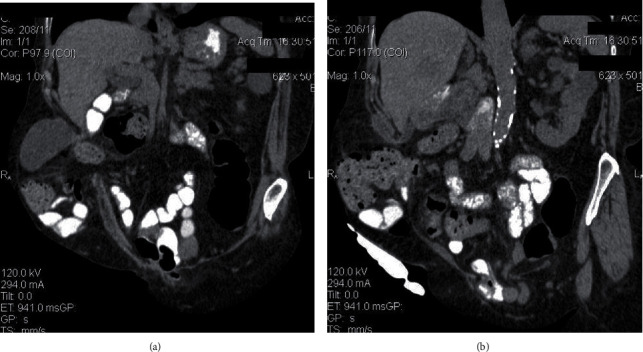 Parastomal Gallbladder Herniation as an Incidental Preoperative Computed Tomography Finding.