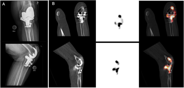 Diagnostic accuracy of SPECT/CT arthrography in patients with suspected aseptic joint prostheses loosening.