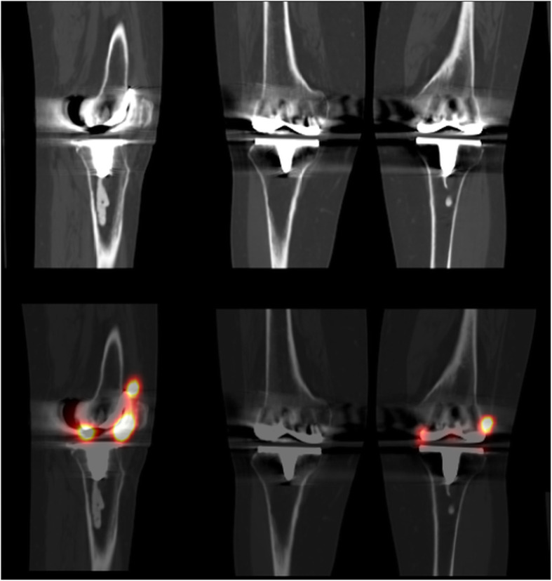 Diagnostic accuracy of SPECT/CT arthrography in patients with suspected aseptic joint prostheses loosening.