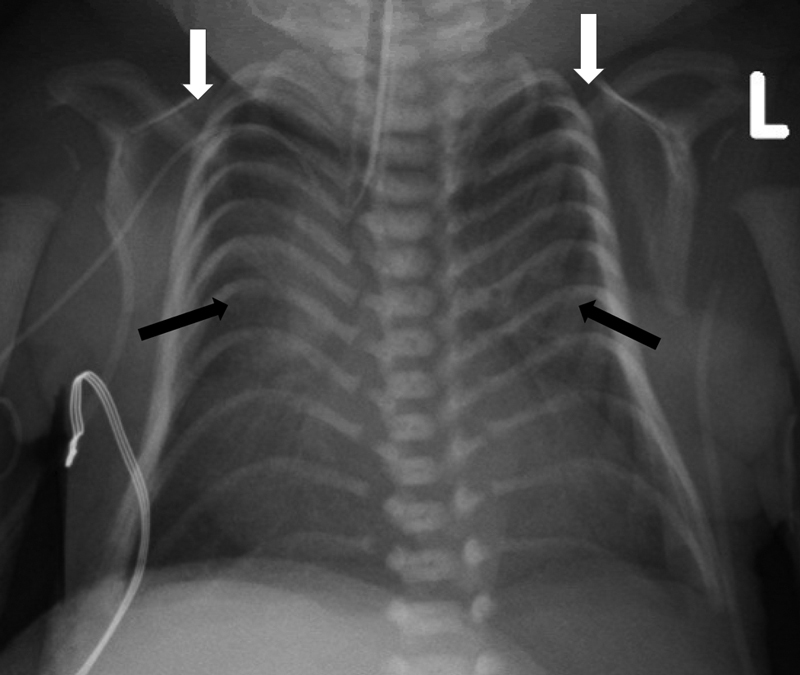 Kagami-Ogata Syndrome: Case Series and Review of Literature.