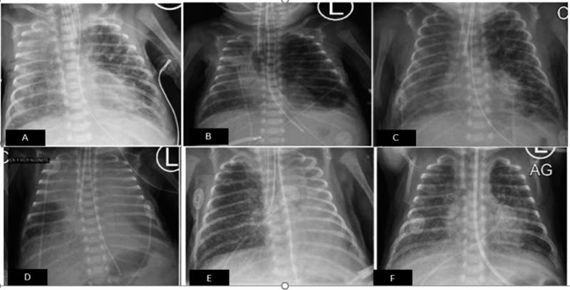 Refractory Pulmonary Interstitial Emphysema in Extreme Premature Newborn.