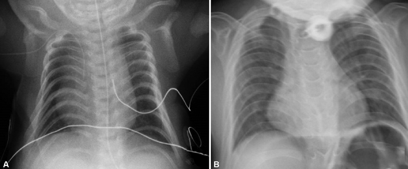 Kagami-Ogata Syndrome: Case Series and Review of Literature.