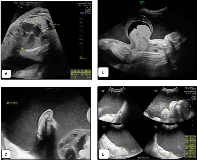 Kagami-Ogata Syndrome: Case Series and Review of Literature.