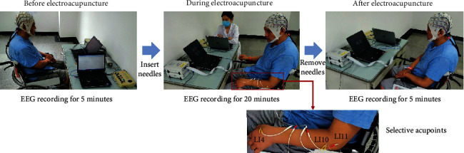 Weakened Effective Connectivity Related to Electroacupuncture in Stroke Patients with Prolonged Flaccid Paralysis: An EEG Pilot Study.