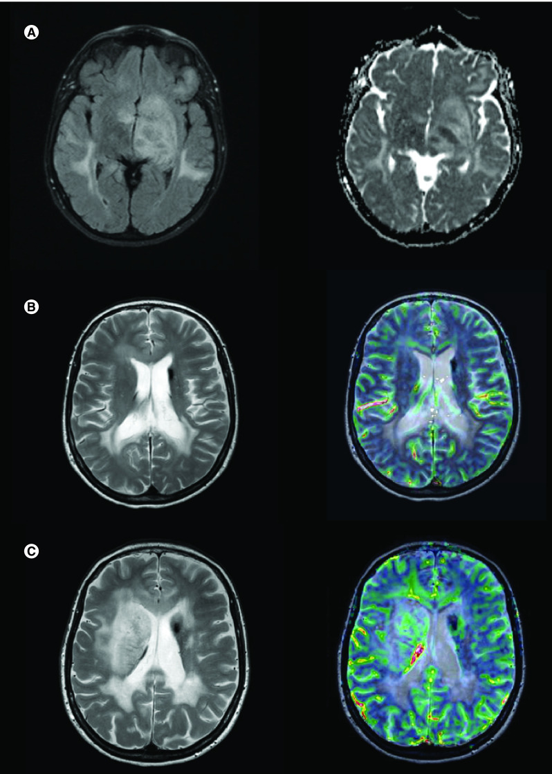 The clinical heterogeneity of entirely nonenhancing CNS lymphoma: a case series.