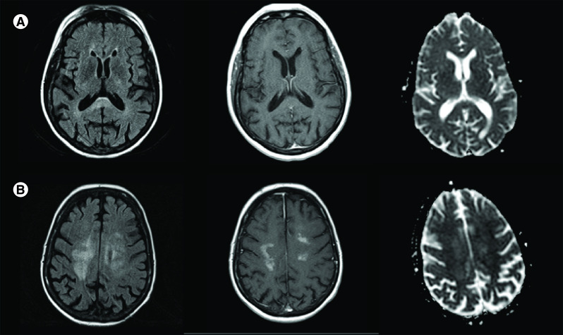 The clinical heterogeneity of entirely nonenhancing CNS lymphoma: a case series.