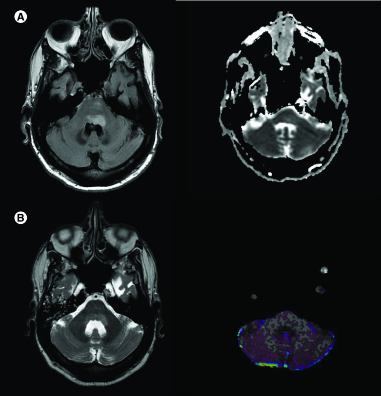 The clinical heterogeneity of entirely nonenhancing CNS lymphoma: a case series.