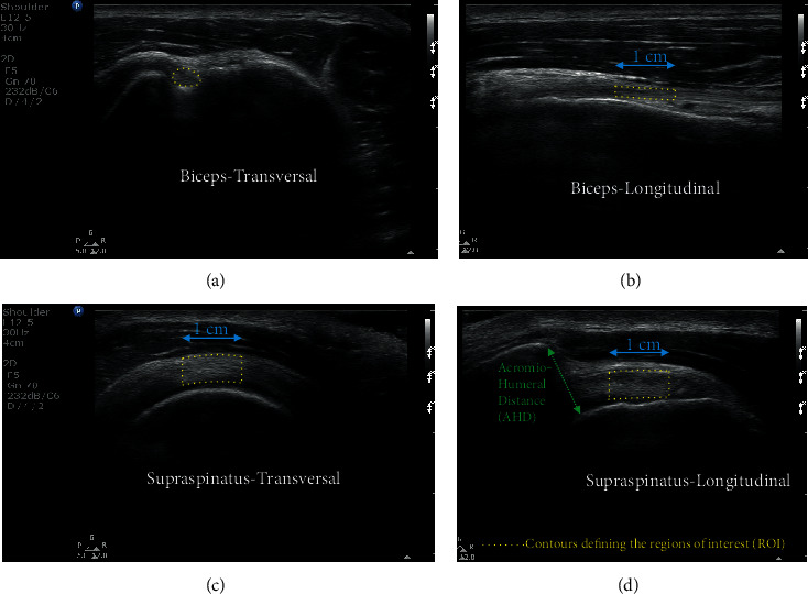 Changes to Biceps and Supraspinatus Tendons in Response to a Progressive Maximal Treadmill-Based Propulsion Aerobic Fitness Test in Manual Wheelchair Users: A Quantitative Musculoskeletal Ultrasound Study.