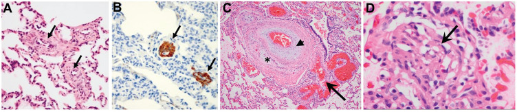 Identifying Potential Mutations Responsible for Cases of Pulmonary Arterial Hypertension.