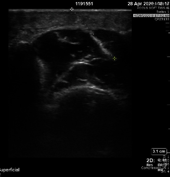 Clinical Considerations in Initial Evaluation and Treatment of Hardhead Catfish Spine Puncture Wounds.