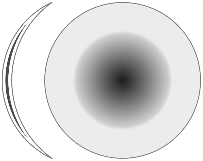 Grey Filter Contact Lens as Therapeutic Option for Acquired Reduced Binocular Visual Performance.