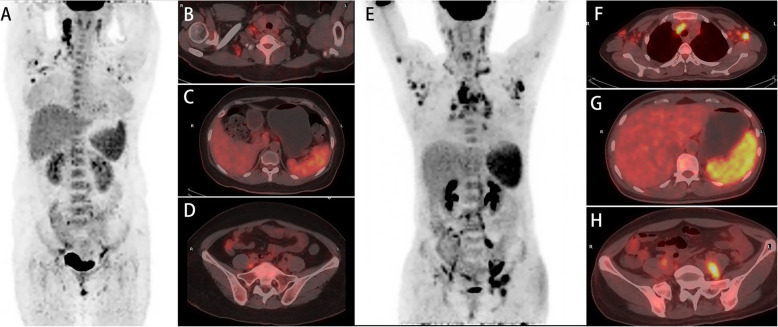 Total metabolic lesion volume of lymph nodes measured by <sup>18</sup>F-FDG PET/CT: a new predictor of macrophage activation syndrome in adult-onset Still's disease.