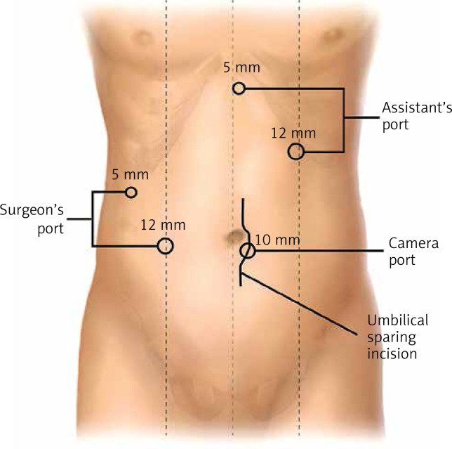 Complete laparoscopic radical resection of hilar cholangiocarcinoma: technical aspects and long-term results from a single center.