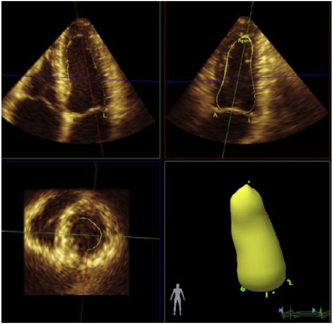 British Society for Echocardiography and British Cardio-Oncology Society guideline for transthoracic echocardiographic assessment of adult cancer patients receiving anthracyclines and/or trastuzumab.