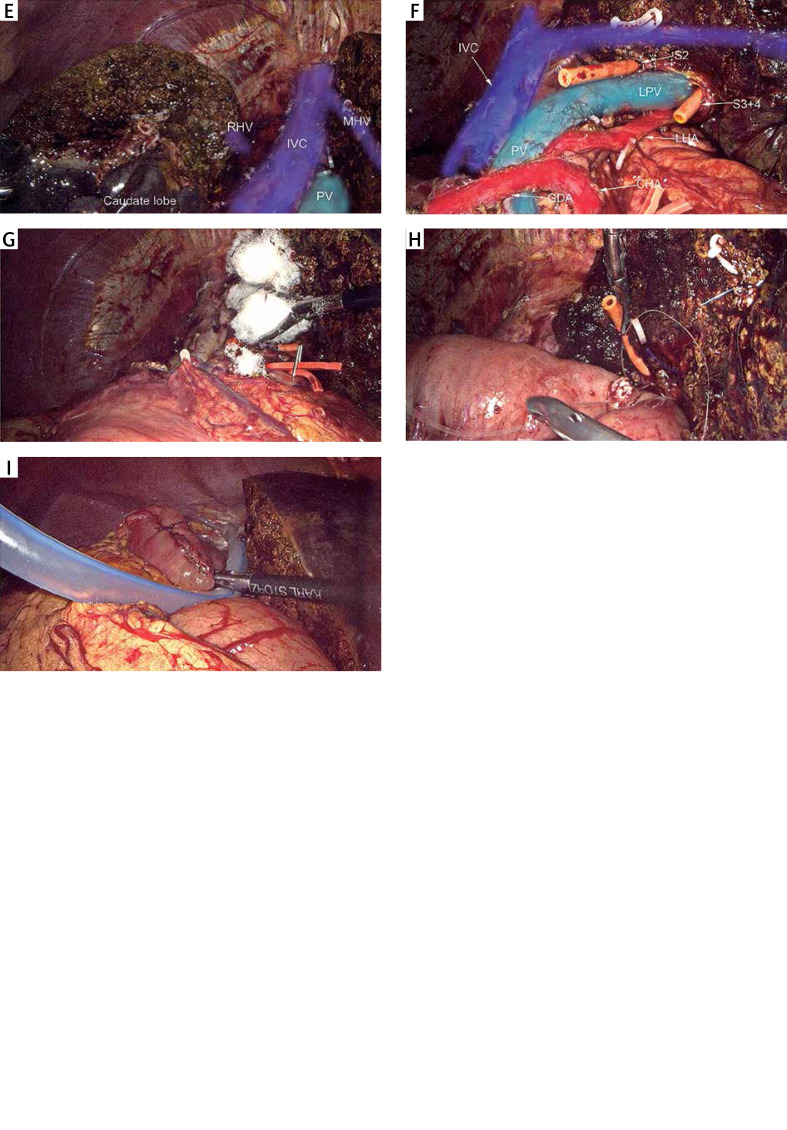 Complete laparoscopic radical resection of hilar cholangiocarcinoma: technical aspects and long-term results from a single center.
