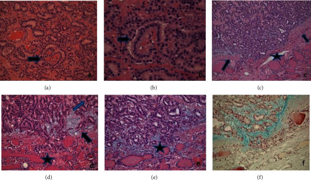 A Case of Follicular Tumor of Uncertain Malignant Potential (FT-UMP) with Glomeruloid Features Showing Capsular Mucinous Degeneration.