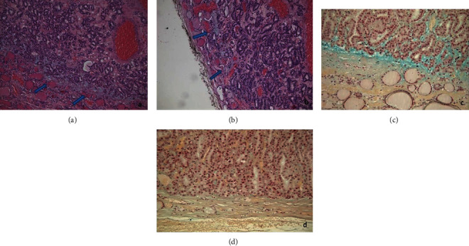 A Case of Follicular Tumor of Uncertain Malignant Potential (FT-UMP) with Glomeruloid Features Showing Capsular Mucinous Degeneration.