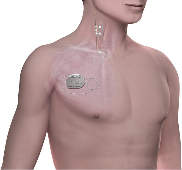 Effect of defibrillation on the performance of an implantable vagus nerve stimulation system.