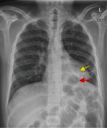 Gastrobronchial Fistula: A Rare Complication of Postlaparascopic Sleeve Gastrectomy-A Case Report and Literature Review.