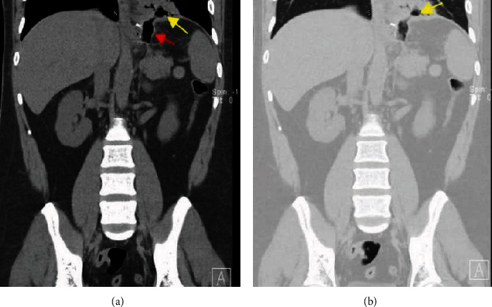 Gastrobronchial Fistula: A Rare Complication of Postlaparascopic Sleeve Gastrectomy-A Case Report and Literature Review.