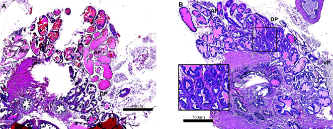 The helix-loop-helix transcriptional regulator Id4 is required for terminal differentiation of luminal epithelial cells in the prostate.