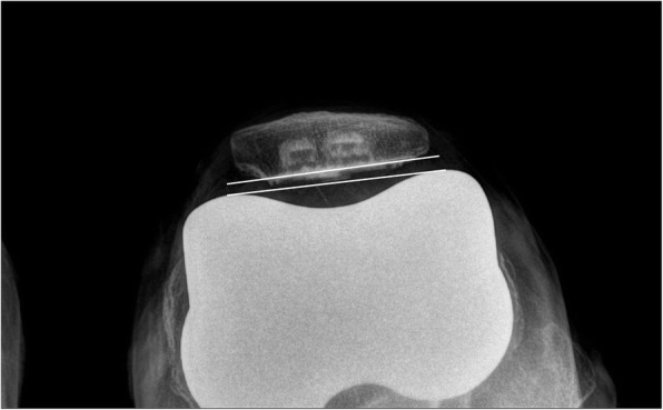 Intraoperative patellar maltracking and postoperative radiographic patellar malalignment were more frequent in cases of complete medial collateral ligament release in cruciate-retaining total knee arthroplasty.