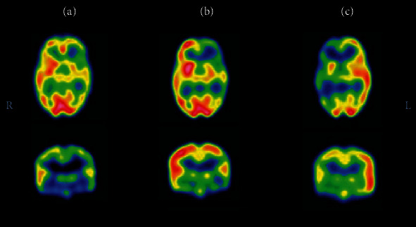 Use of Innovative SPECT Techniques in the Presurgical Evaluation of Patients with Nonlesional Extratemporal Drug-Resistant Epilepsy.