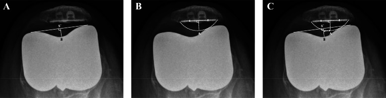 Intraoperative patellar maltracking and postoperative radiographic patellar malalignment were more frequent in cases of complete medial collateral ligament release in cruciate-retaining total knee arthroplasty.