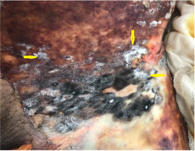 A rare <i>Fusarium equiseti</i> infection in a 53-year-old male with burn injury: A case report.