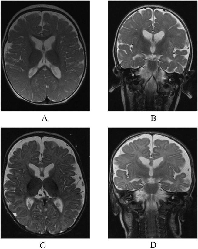 Beyond a routine blood gas, an easily picked but missed diagnosis of chronic Encephalopathy