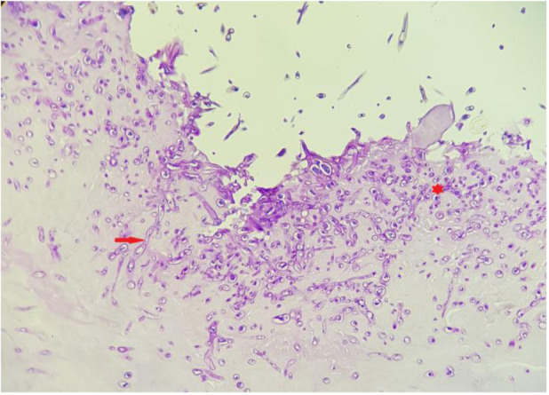 A rare <i>Fusarium equiseti</i> infection in a 53-year-old male with burn injury: A case report.