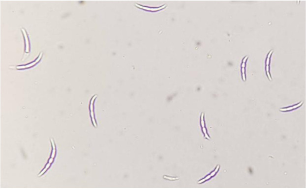 A rare <i>Fusarium equiseti</i> infection in a 53-year-old male with burn injury: A case report.