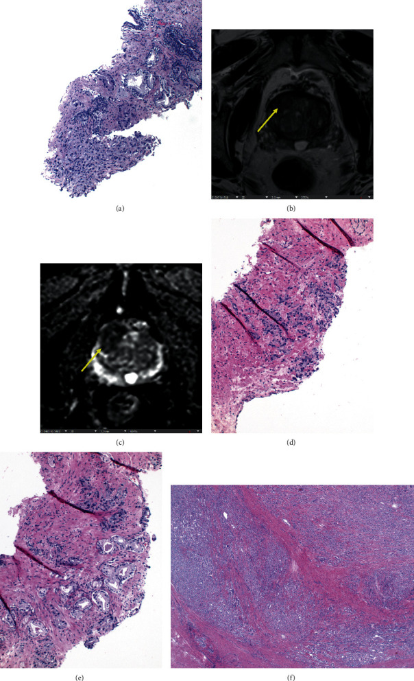 Doubling of Decipher Biopsy Genomic Score Is Related to Disease Reclassification on Subsequent Surveillance Biopsy but Not Adverse Features on Radical Prostatectomy.