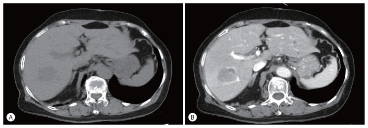 A Case of Lymphocyte-Rich Hepatocellular Carcinoma in a Patient Who Was Treated for Colon Cancer.