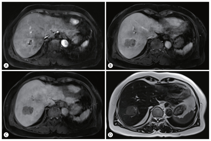 A Case of Lymphocyte-Rich Hepatocellular Carcinoma in a Patient Who Was Treated for Colon Cancer.