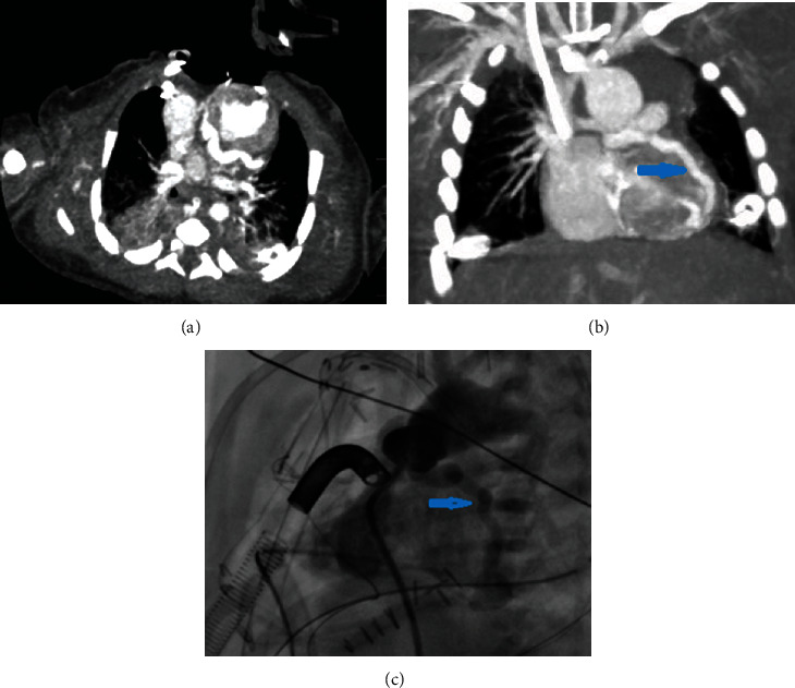 Ventriculocoronary Fistulas with Hypoplastic Left Heart in a Neonate: Imaging with Cardiac CT.