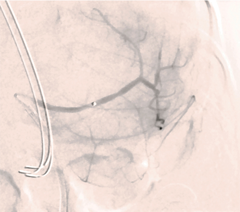 Neonatal Rupture of the Spleen: Successful Treatment with Splenic Artery Embolization.