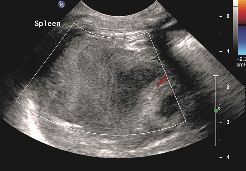 Neonatal Rupture of the Spleen: Successful Treatment with Splenic Artery Embolization.