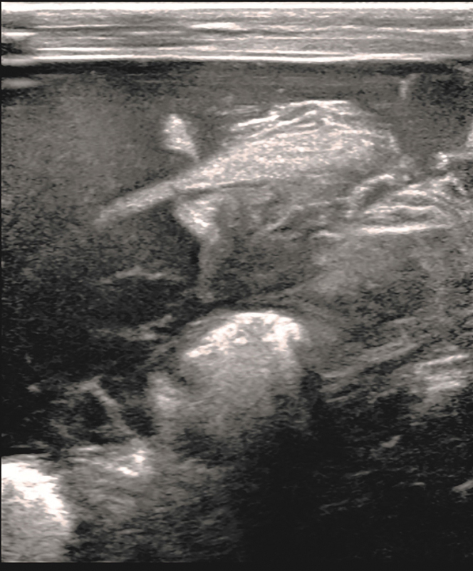 Neonatal Rupture of the Spleen: Successful Treatment with Splenic Artery Embolization.