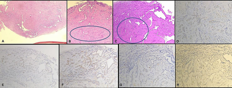 An Unusual Case of Genital Lesion: A Vulvar Syringoma.