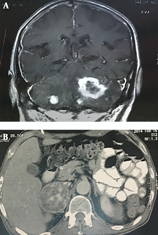 Clinical and Laboratory Characteristics of a Large Iranian Kindred Afflicted with Von Hippel Lindau Disease.