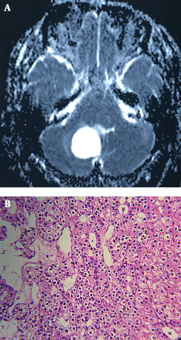 Clinical and Laboratory Characteristics of a Large Iranian Kindred Afflicted with Von Hippel Lindau Disease.