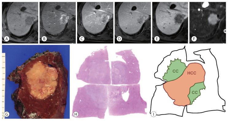 Update on Pathologic and Radiologic Diagnosis of Combined Hepatocellular-Cholangiocarcinoma.