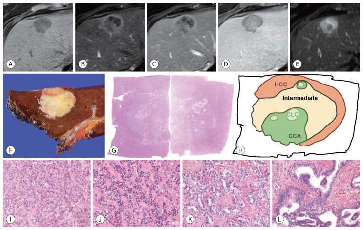 Update on Pathologic and Radiologic Diagnosis of Combined Hepatocellular-Cholangiocarcinoma.